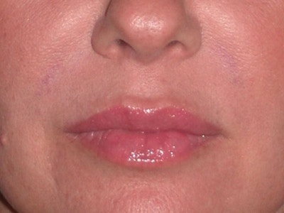 Juvéderm - Lips Before & After Gallery - Patient 326568 - Image 2