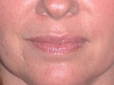 Juvéderm - Lips Before & After Gallery - Patient 326568 - Image 1