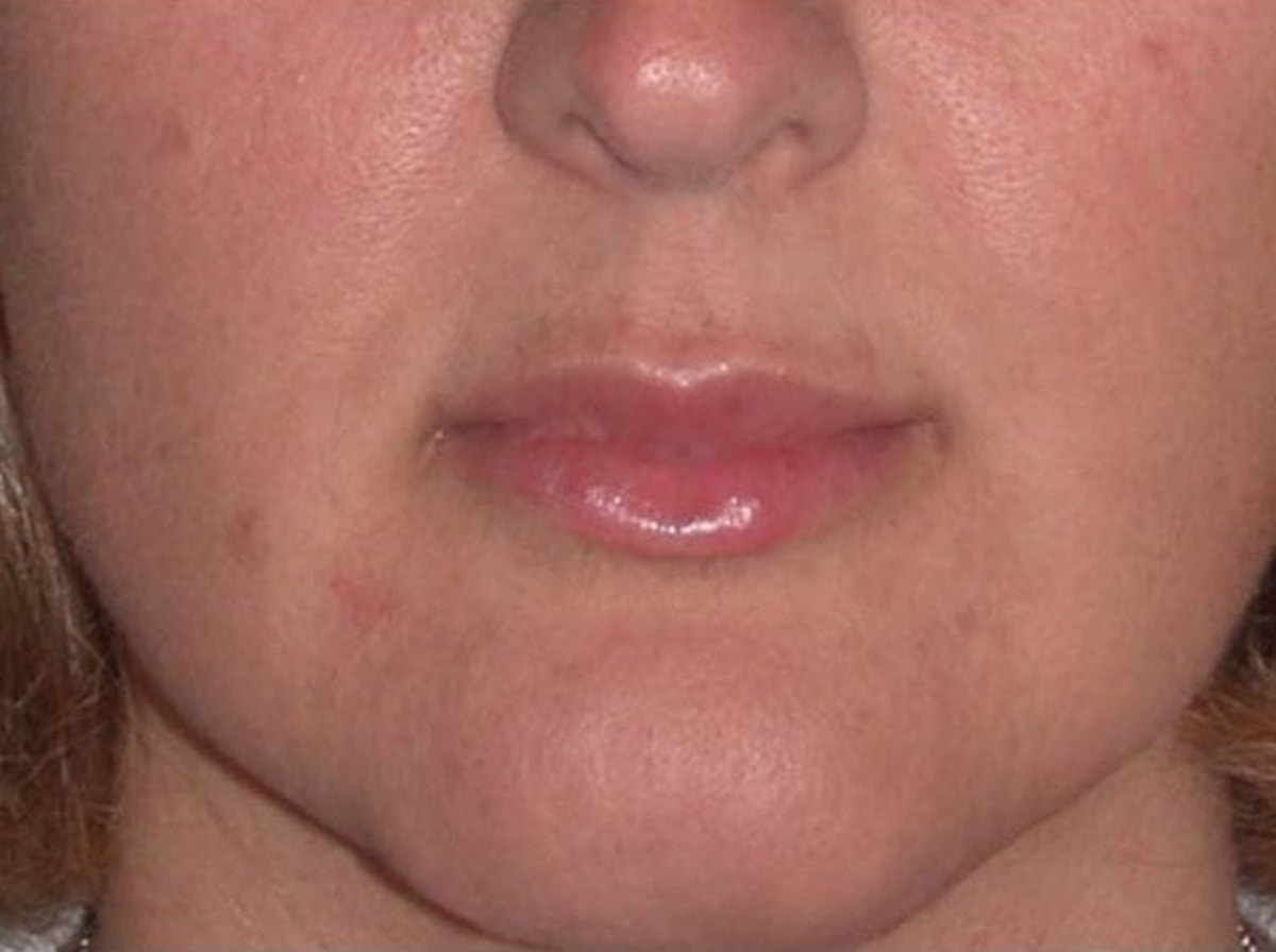 Juvéderm - Lips Before & After Gallery - Patient 389405 - Image 2