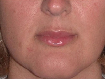 Juvéderm - Lips Before & After Gallery - Patient 389405 - Image 2