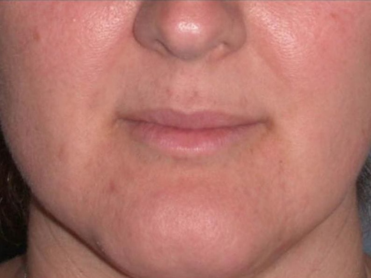 Juvéderm - Lips Before & After Gallery - Patient 389405 - Image 1