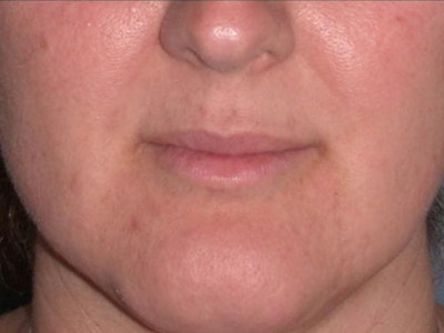Juvéderm - Lips Before & After Gallery - Patient 389405 - Image 1