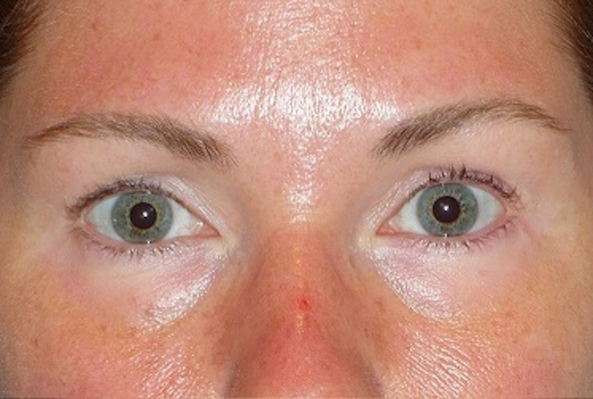 Juvéderm - Tear Troughs Before & After Gallery - Patient 208065 - Image 1