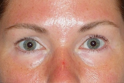Juvéderm - Tear Troughs Before & After Gallery - Patient 208065 - Image 1