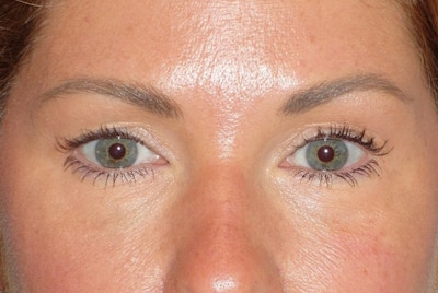 Juvéderm - Tear Troughs Before & After Gallery - Patient 208065 - Image 2