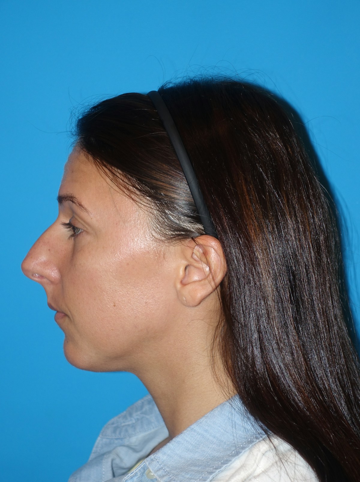Rhinoplasty Before & After Gallery - Patient 430248 - Image 1