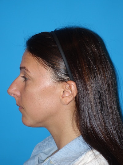 Rhinoplasty Before & After Gallery - Patient 430248 - Image 1