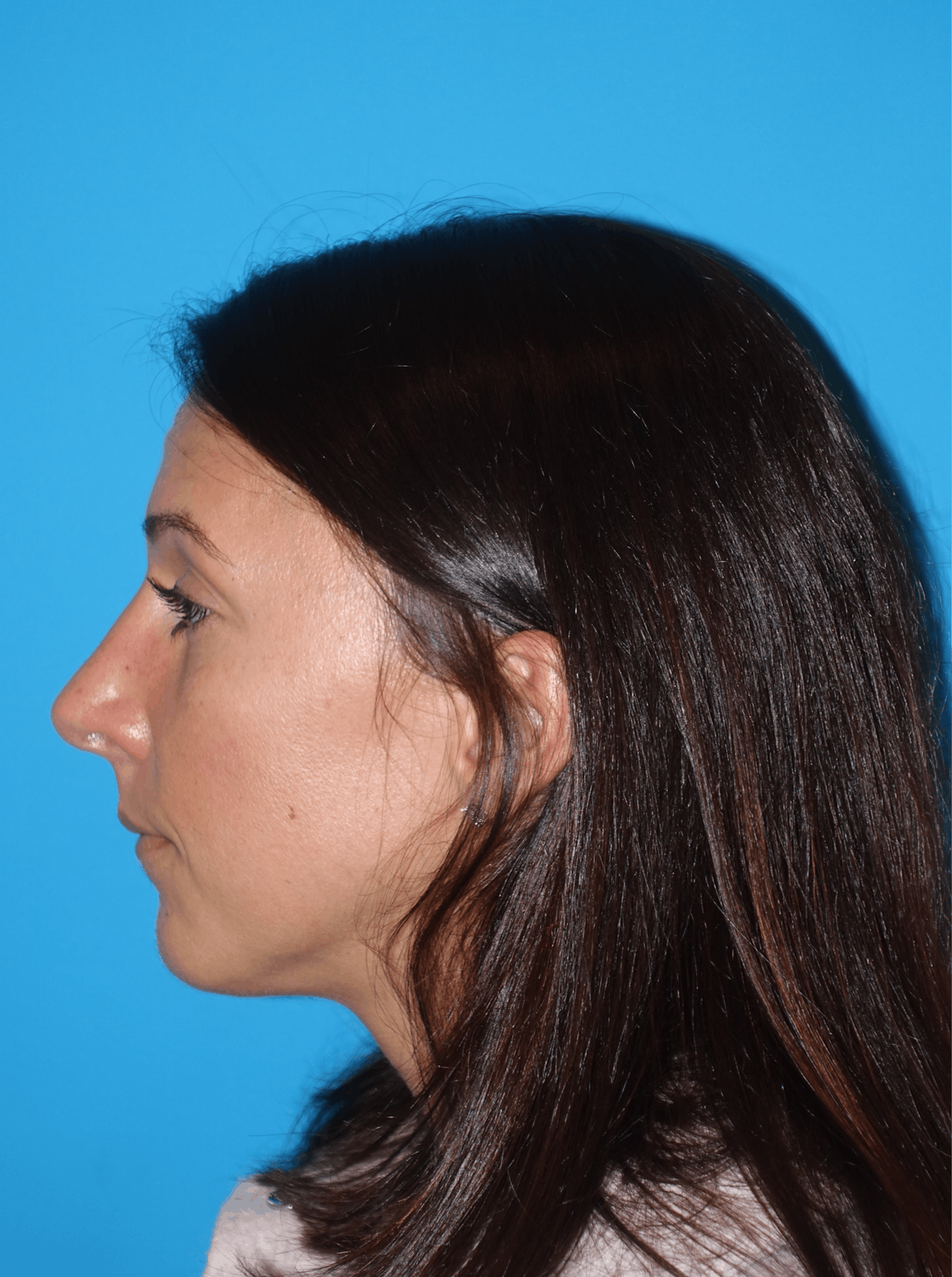 Rhinoplasty Before & After Gallery - Patient 430248 - Image 2