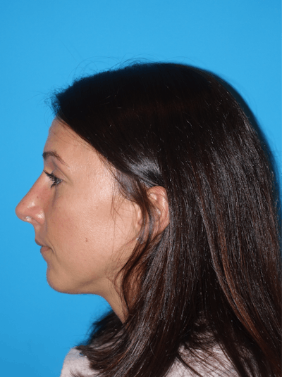 Rhinoplasty Before & After Gallery - Patient 430248 - Image 2