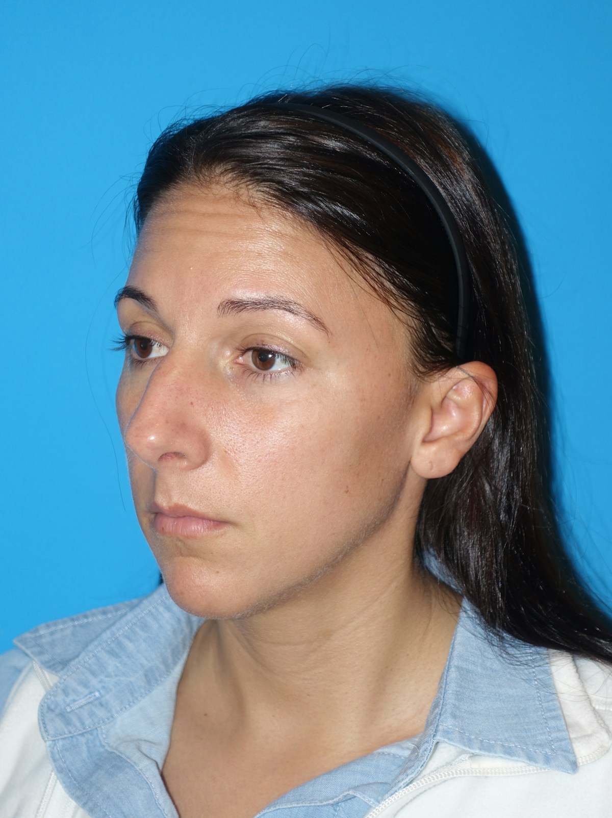 Rhinoplasty Before & After Gallery - Patient 430248 - Image 3