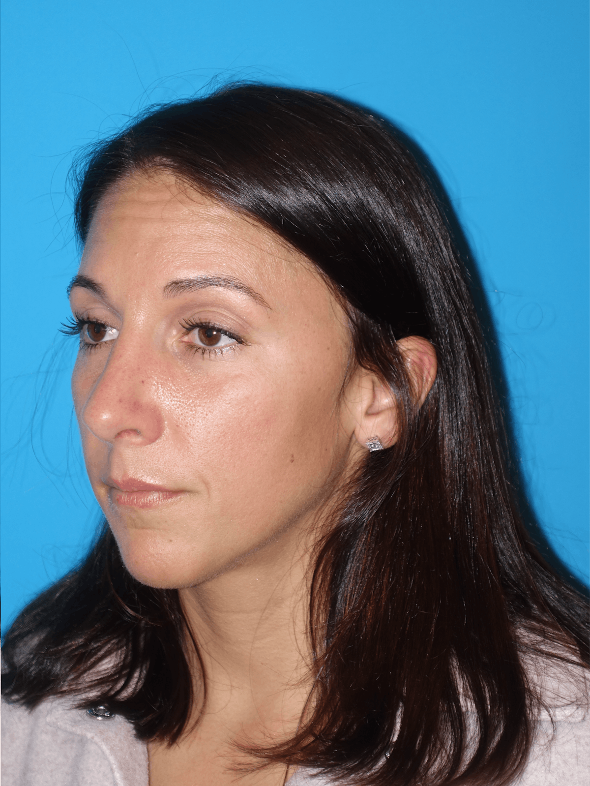 Rhinoplasty Before & After Gallery - Patient 430248 - Image 4