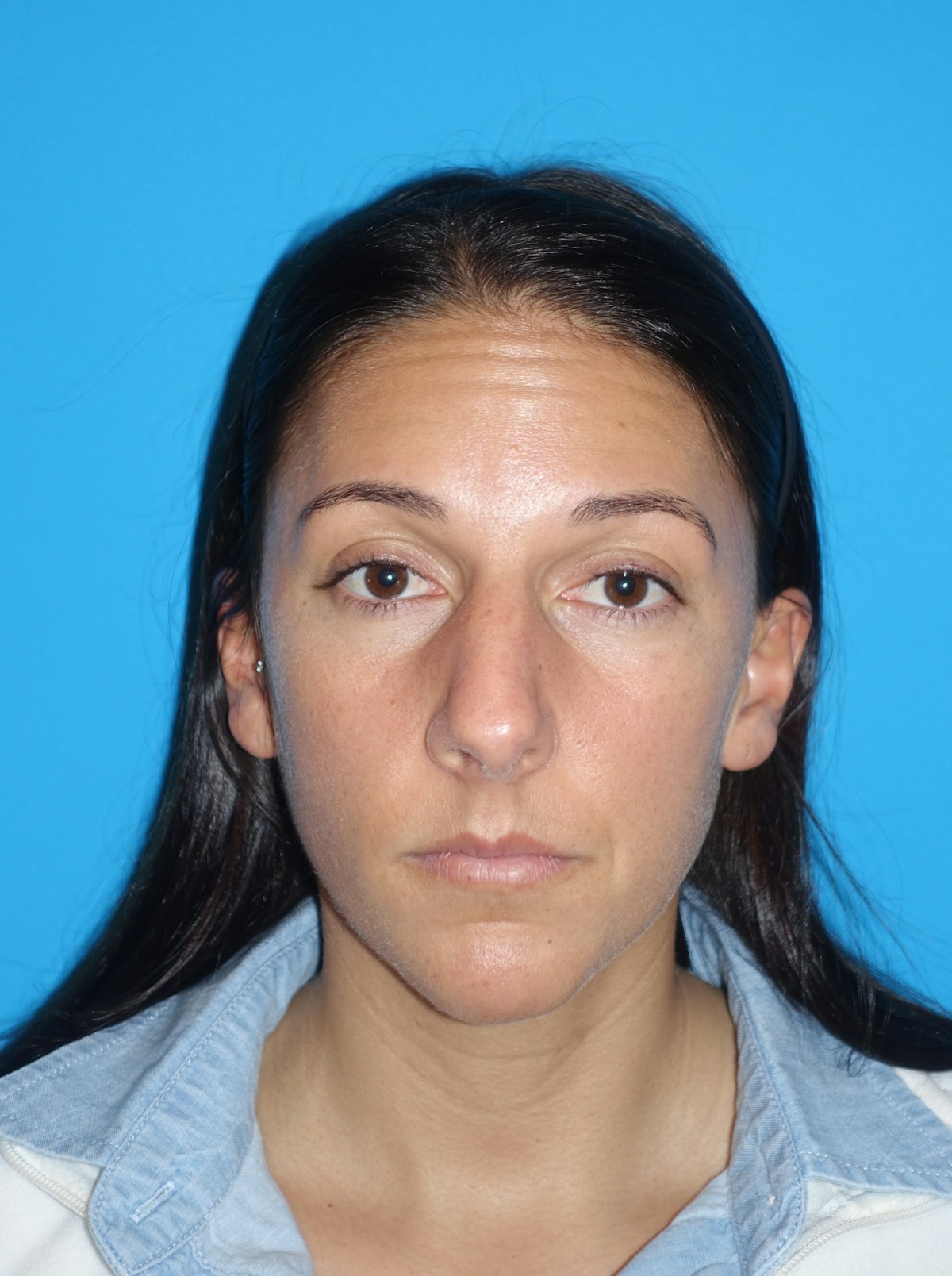 Rhinoplasty Before & After Gallery - Patient 430248 - Image 5