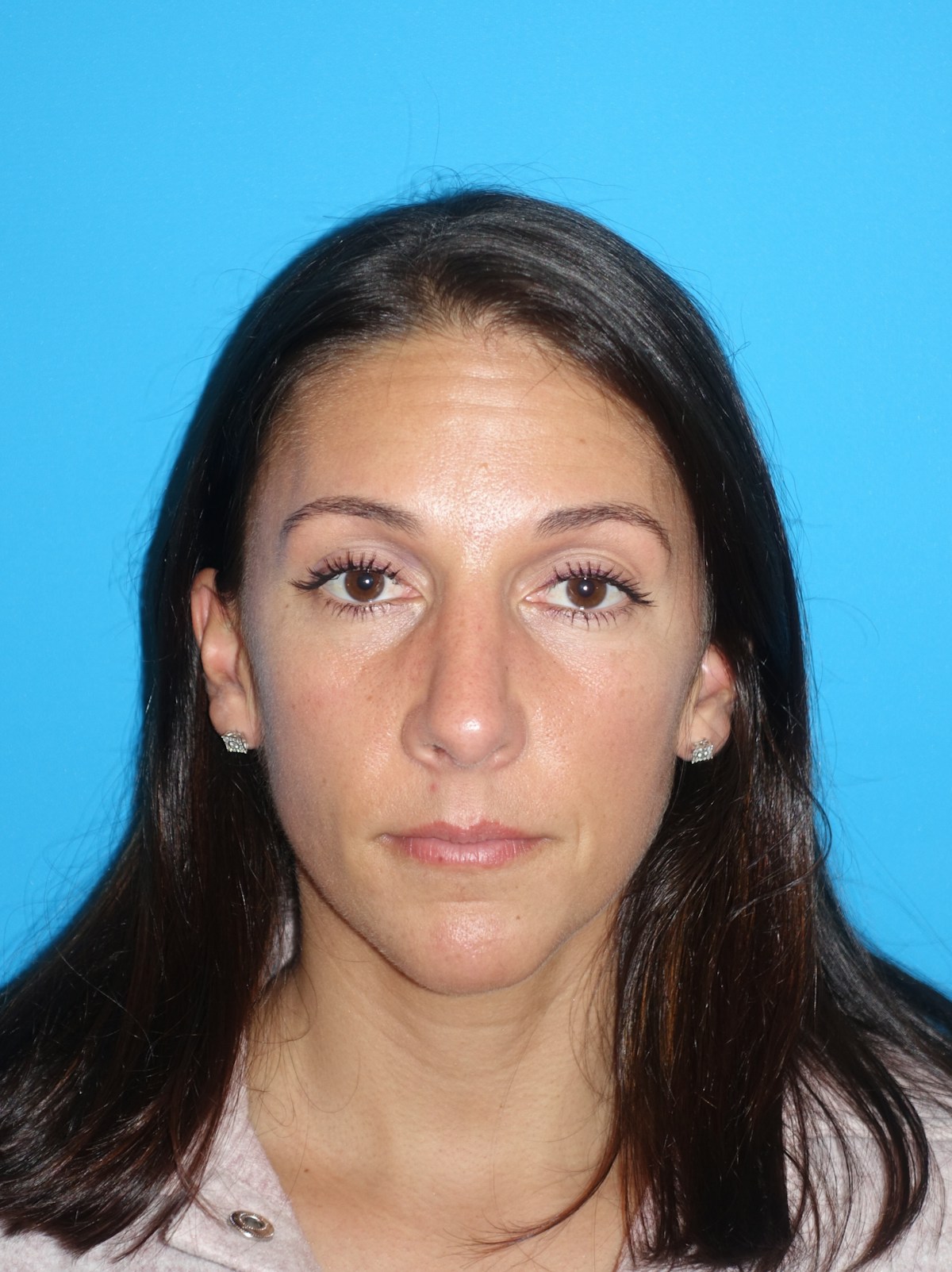 Rhinoplasty Before & After Gallery - Patient 430248 - Image 6