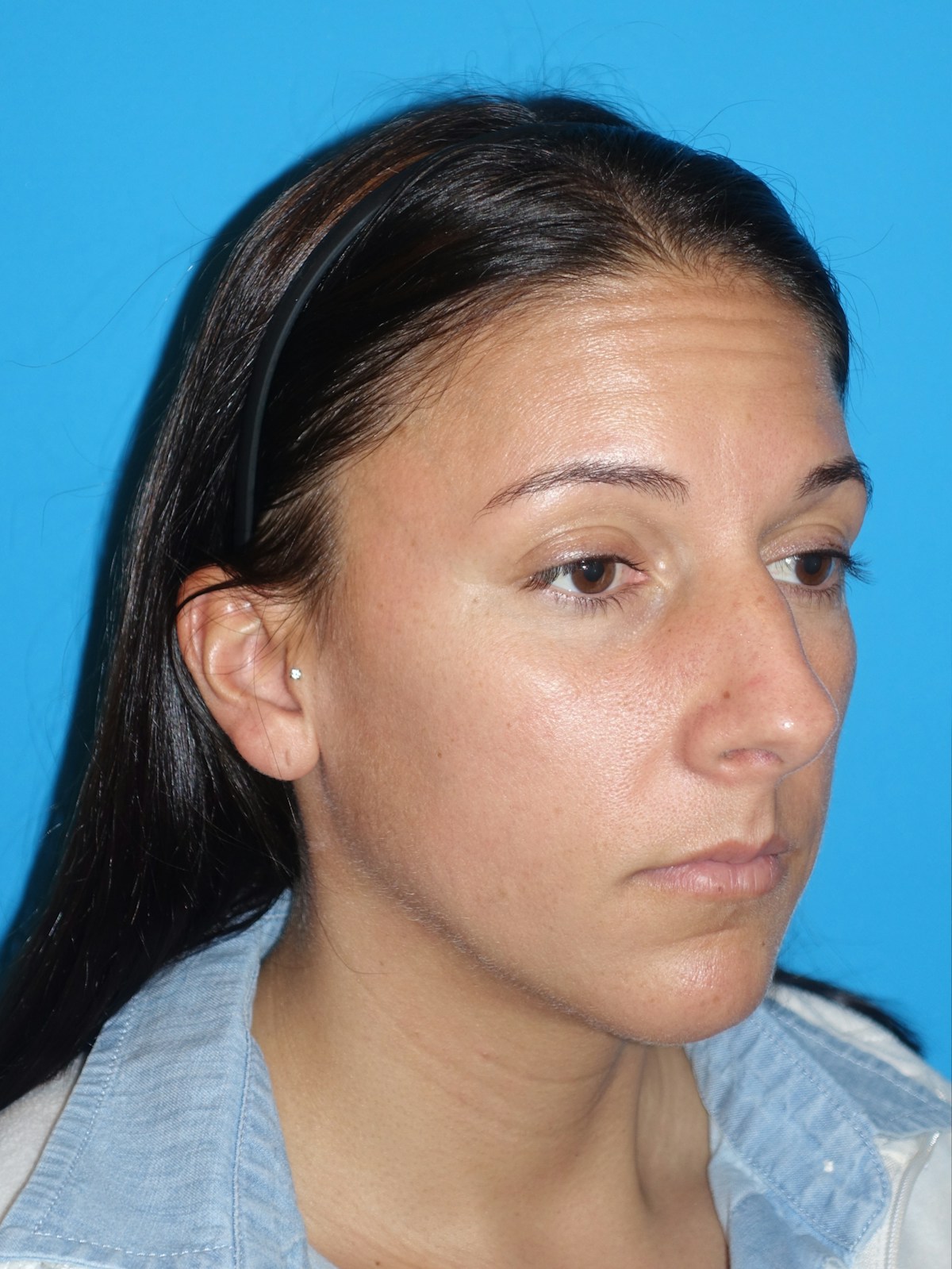 Rhinoplasty Before & After Gallery - Patient 430248 - Image 7