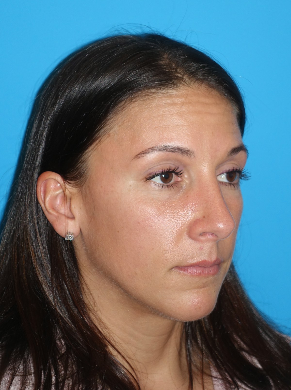 Rhinoplasty Before & After Gallery - Patient 430248 - Image 8