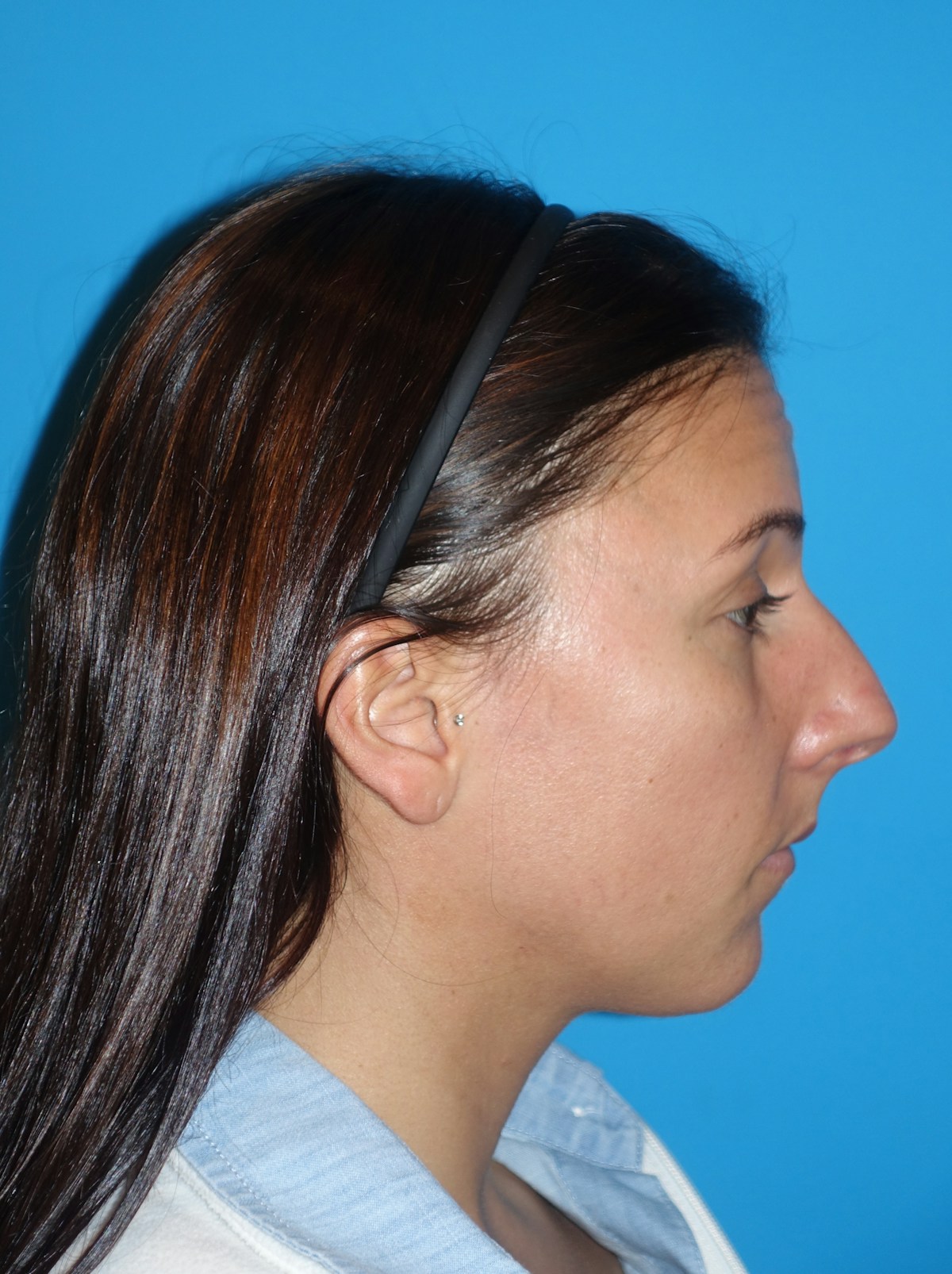 Rhinoplasty Before & After Gallery - Patient 430248 - Image 9