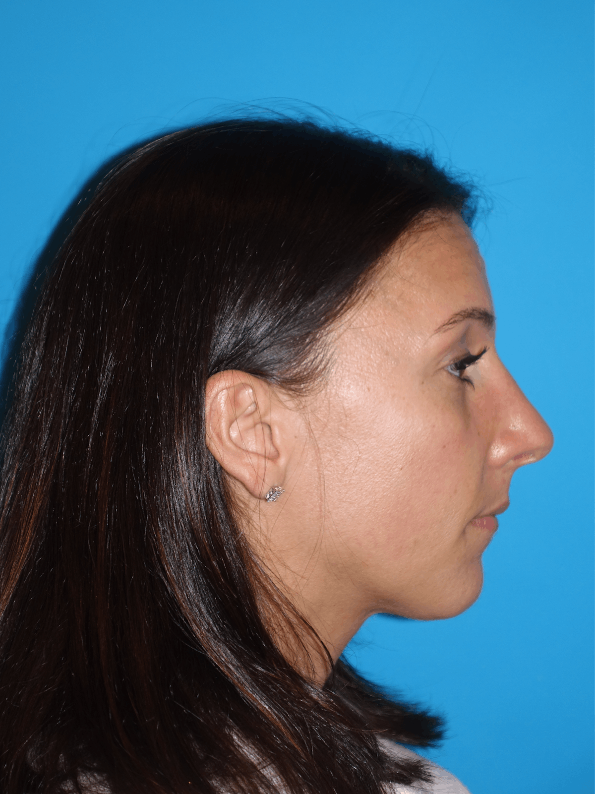 Rhinoplasty Before & After Gallery - Patient 430248 - Image 10