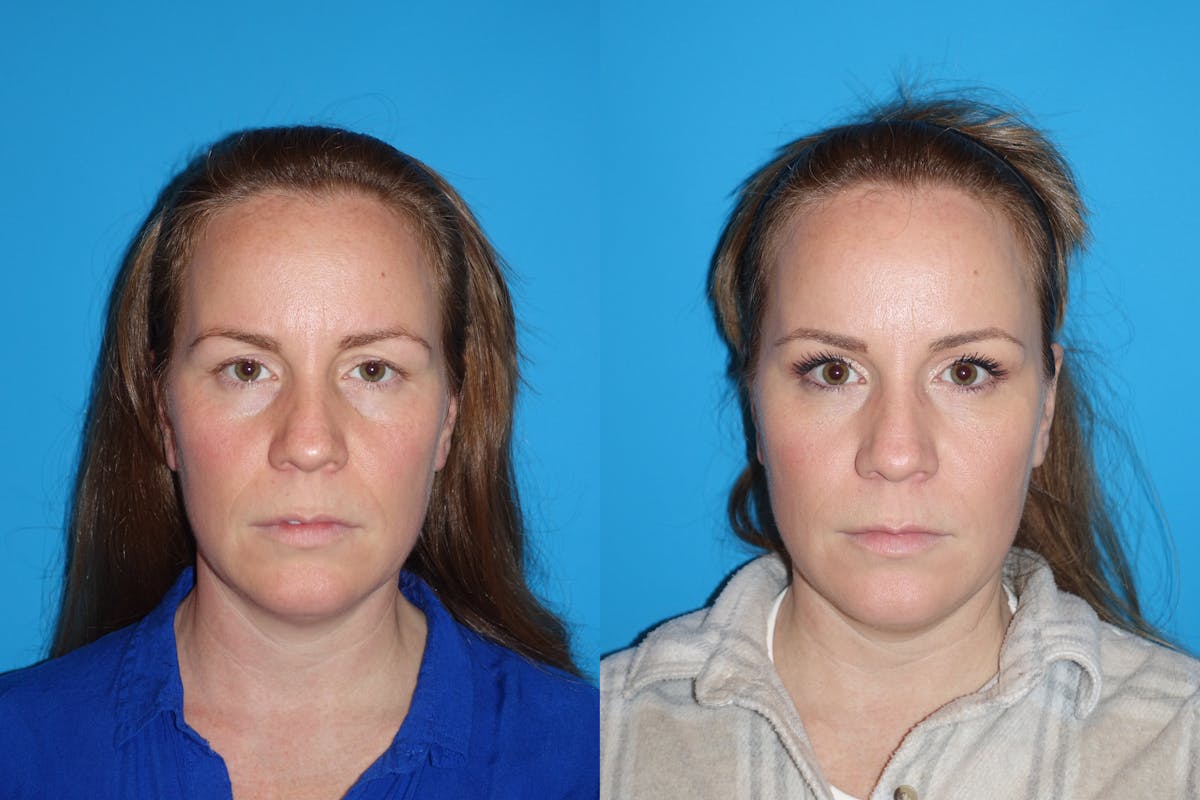 Eyelid Lift- Lower Before & After Gallery - Patient 402431 - Image 1