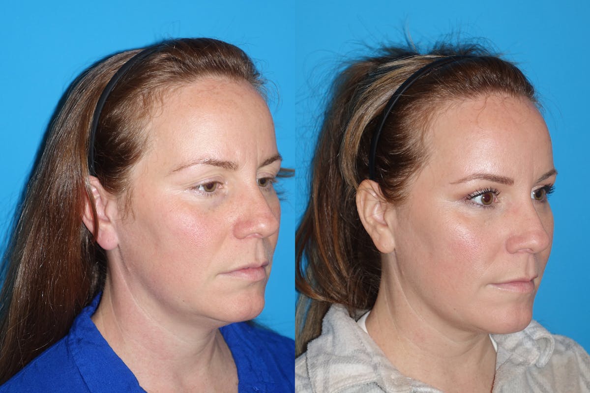 Eyelid Lift- Lower Before & After Gallery - Patient 402431 - Image 2