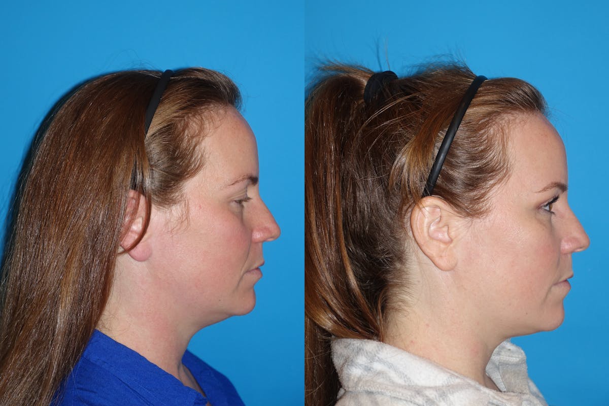 Eyelid Lift- Lower Before & After Gallery - Patient 402431 - Image 3