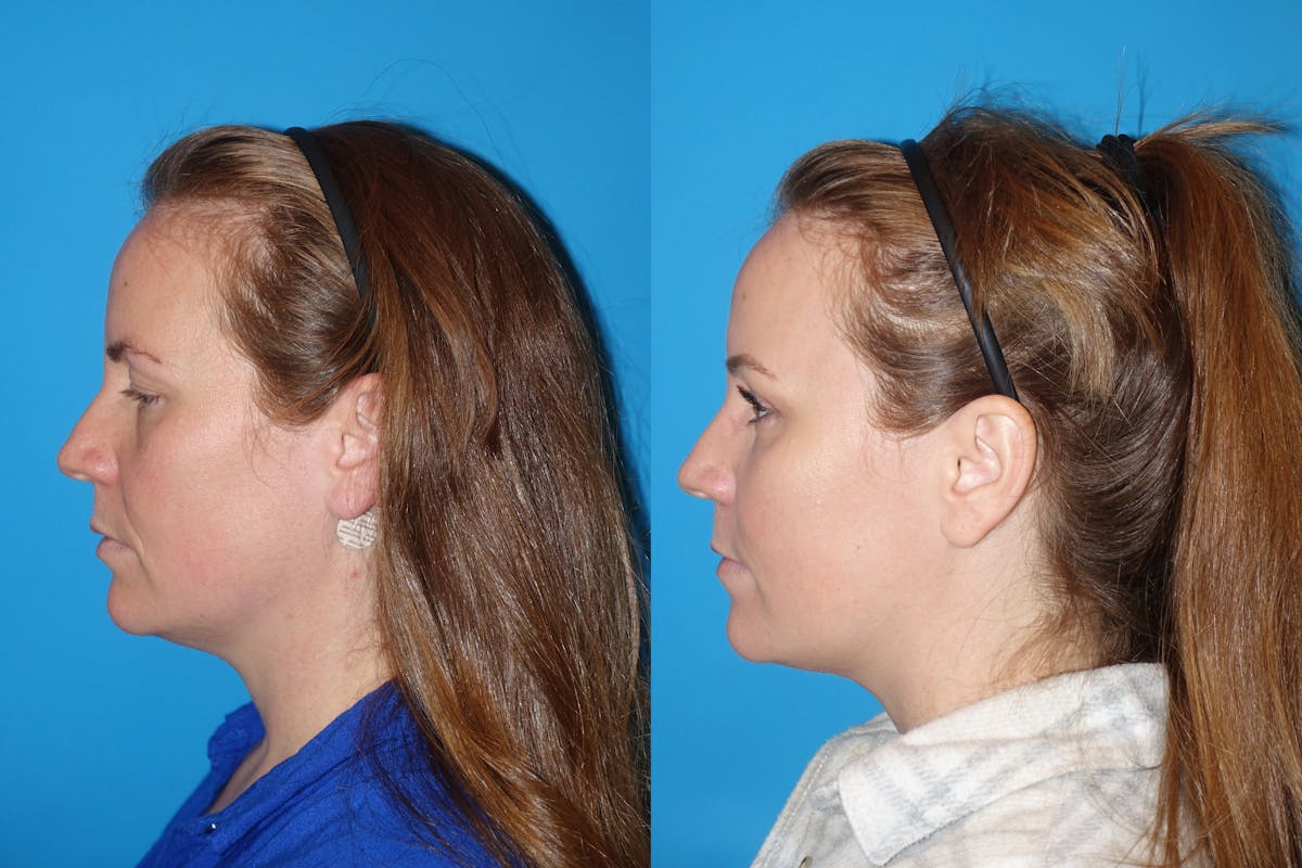 Eyelid Lift- Lower Before & After Gallery - Patient 402431 - Image 5