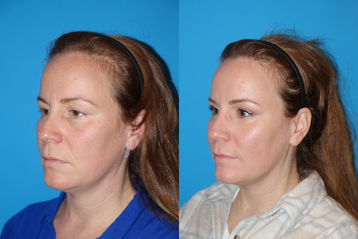 Eyelid Lift- Lower Before & After Gallery - Patient 402431 - Image 4