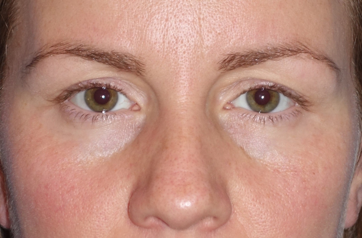 Eyelid Lift- Upper Before & After Gallery - Patient 207634 - Image 1