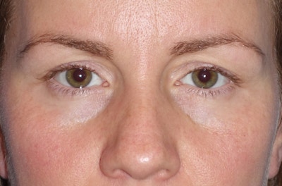 Eyelid Lift- Upper Before & After Gallery - Patient 207634 - Image 1