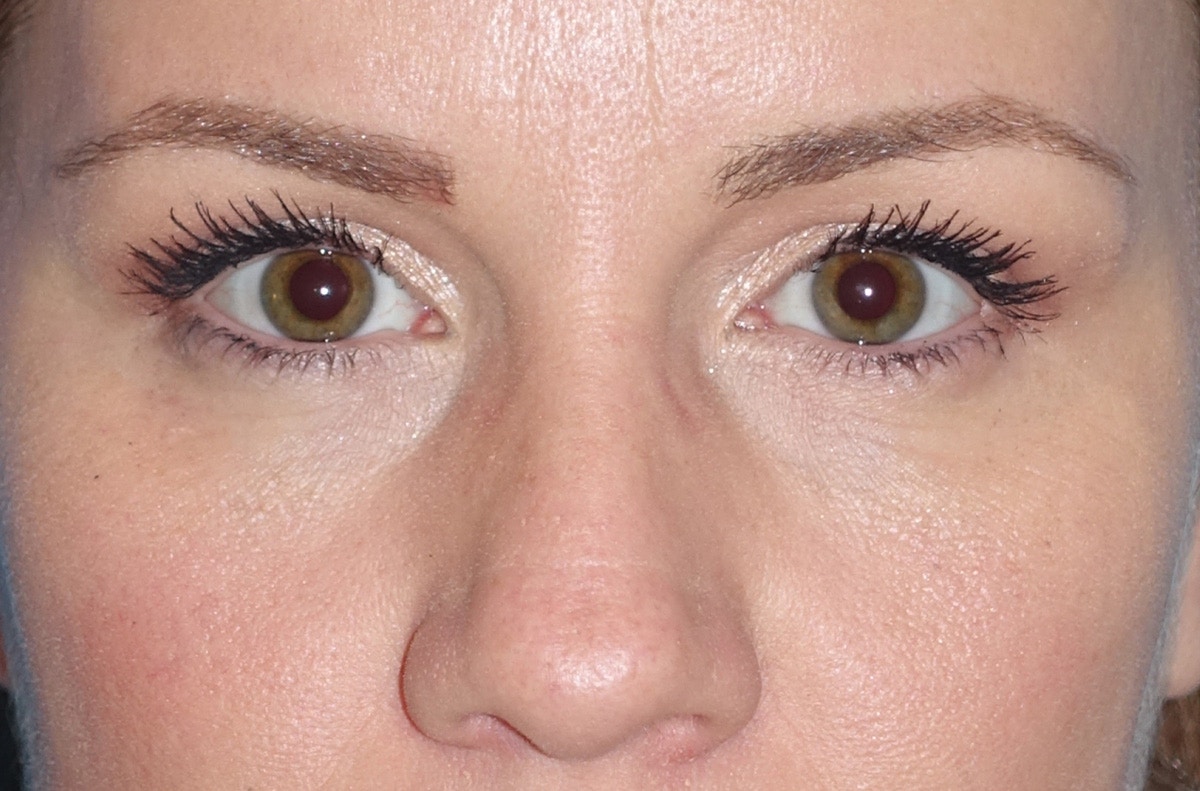 Eyelid Lift- Upper Before & After Gallery - Patient 207634 - Image 2