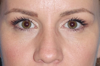 Eyelid Lift- Upper Before & After Gallery - Patient 207634 - Image 2