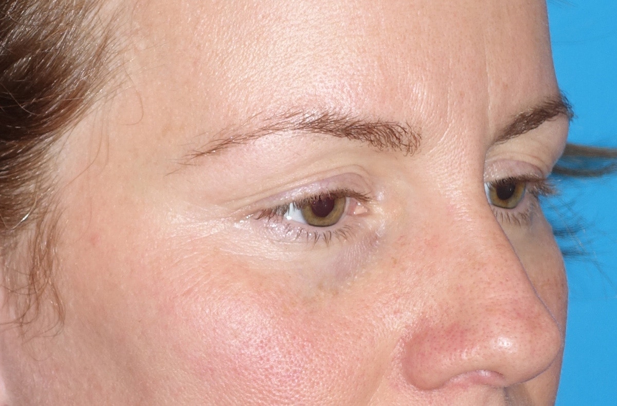 Eyelid Lift- Upper Before & After Gallery - Patient 207634 - Image 3