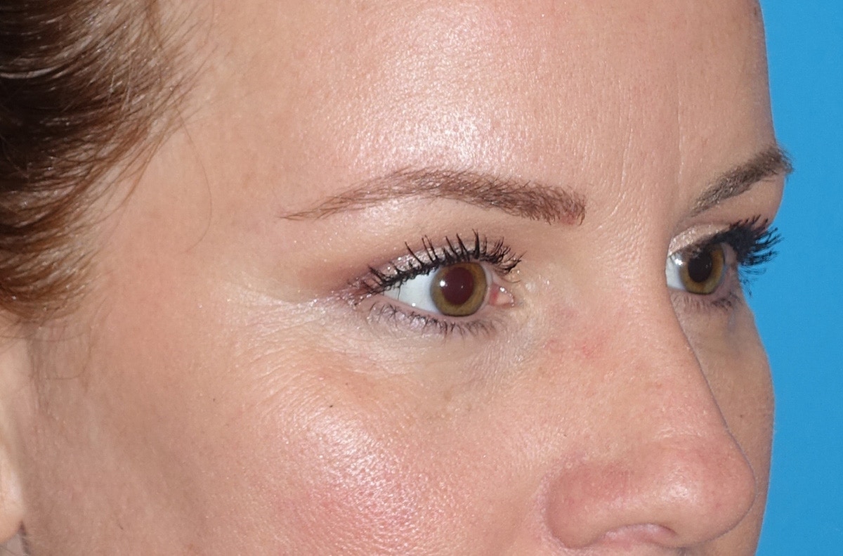 Eyelid Lift- Upper Before & After Gallery - Patient 207634 - Image 4
