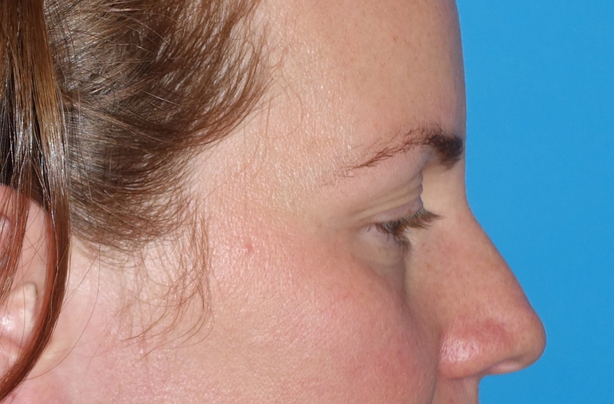 Eyelid Lift- Upper Before & After Gallery - Patient 207634 - Image 5