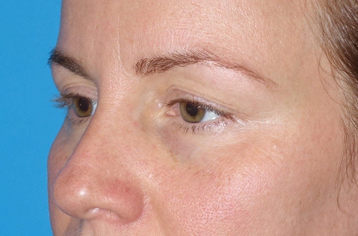 Eyelid Lift- Upper Before & After Gallery - Patient 207634 - Image 7