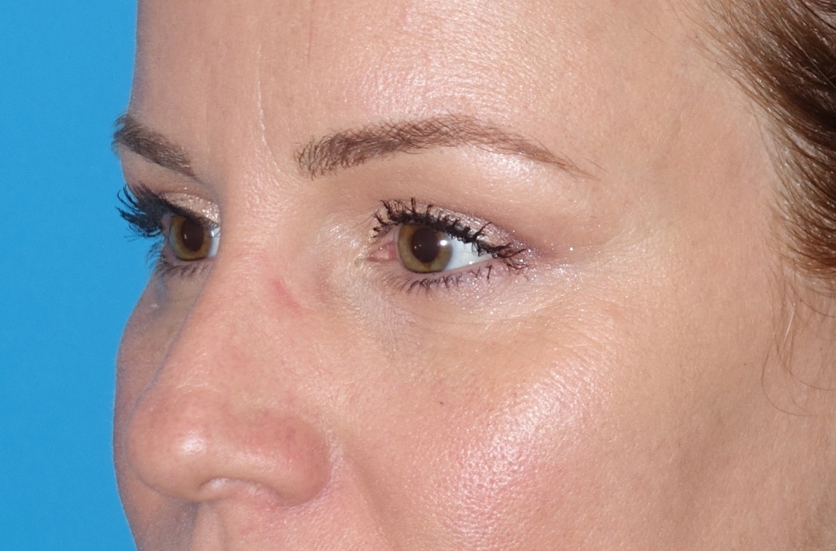 Eyelid Lift- Upper Before & After Gallery - Patient 207634 - Image 8