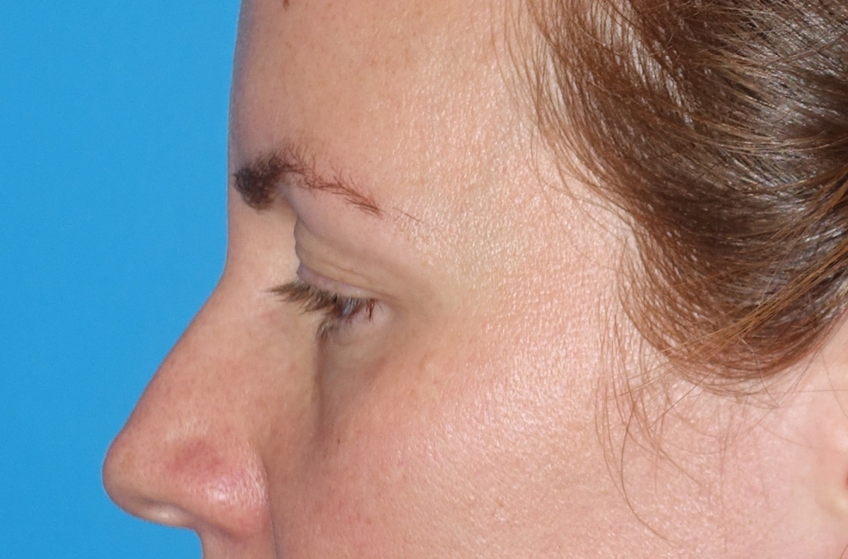 Eyelid Lift- Upper Before & After Gallery - Patient 207634 - Image 9