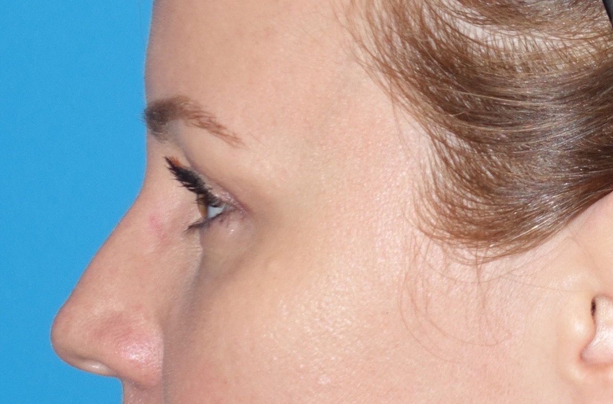 Eyelid Lift- Upper Before & After Gallery - Patient 207634 - Image 10