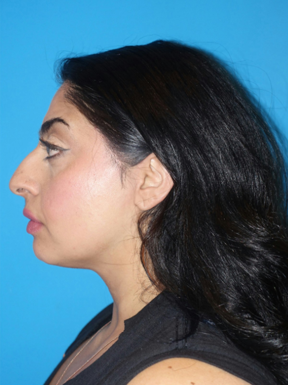 Rhinoplasty Before & After Gallery - Patient 975848 - Image 1