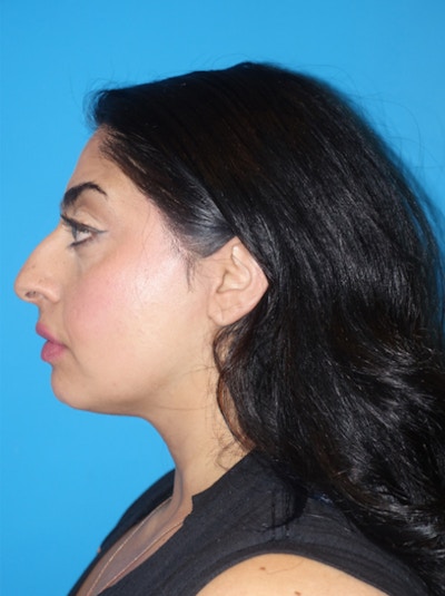 Rhinoplasty Before & After Gallery - Patient 975848 - Image 1