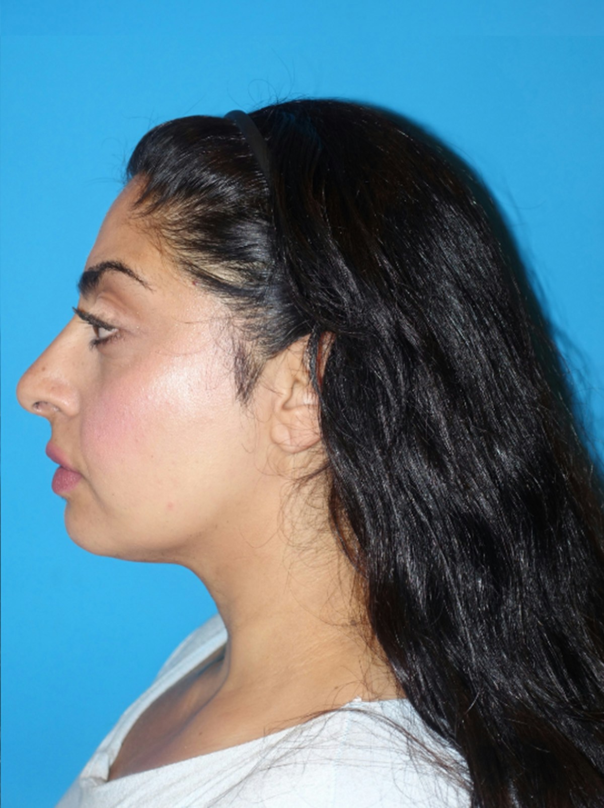 Rhinoplasty Before & After Gallery - Patient 975848 - Image 2