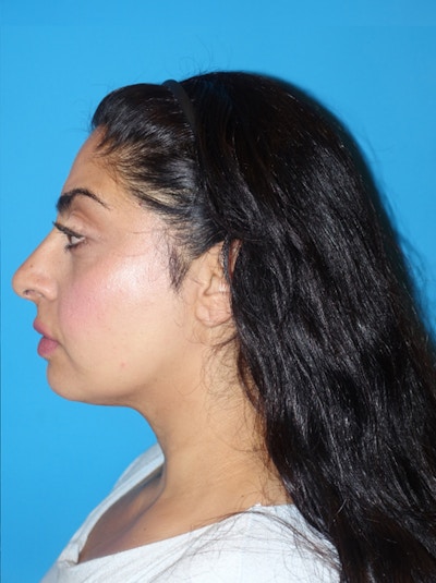Rhinoplasty Before & After Gallery - Patient 975848 - Image 2