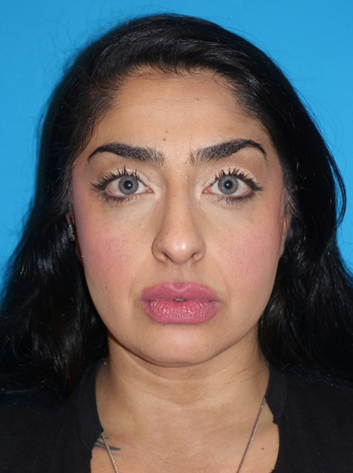 Rhinoplasty Before & After Gallery - Patient 975848 - Image 3