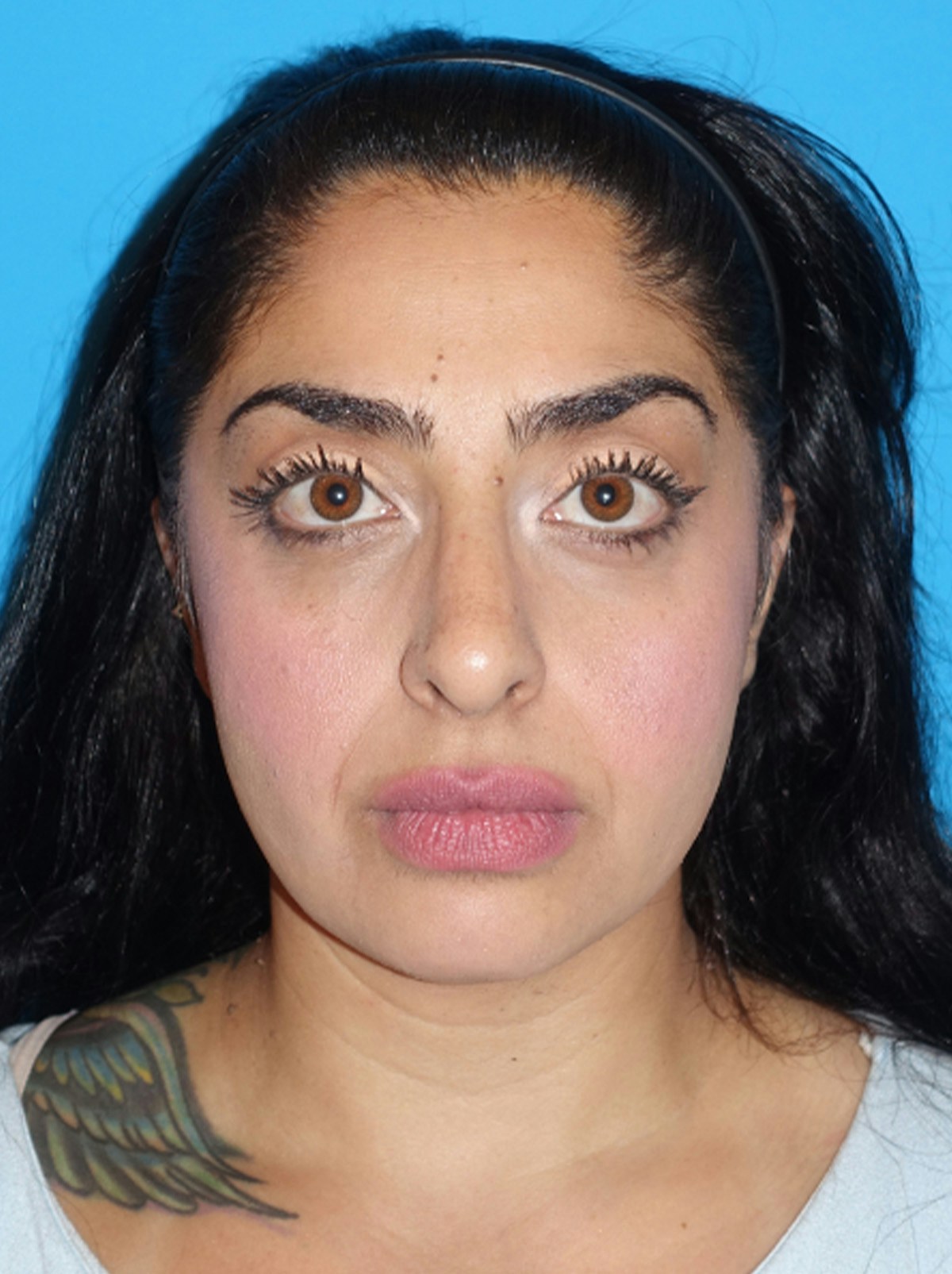 Rhinoplasty Before & After Gallery - Patient 975848 - Image 4