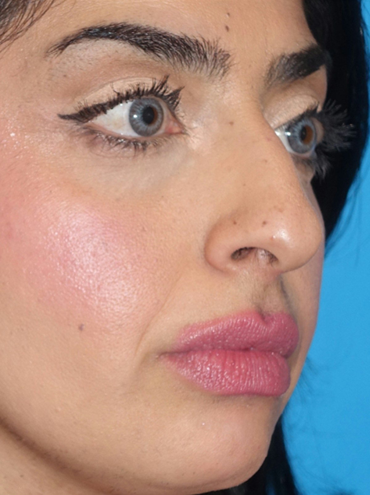 Rhinoplasty Before & After Gallery - Patient 975848 - Image 5