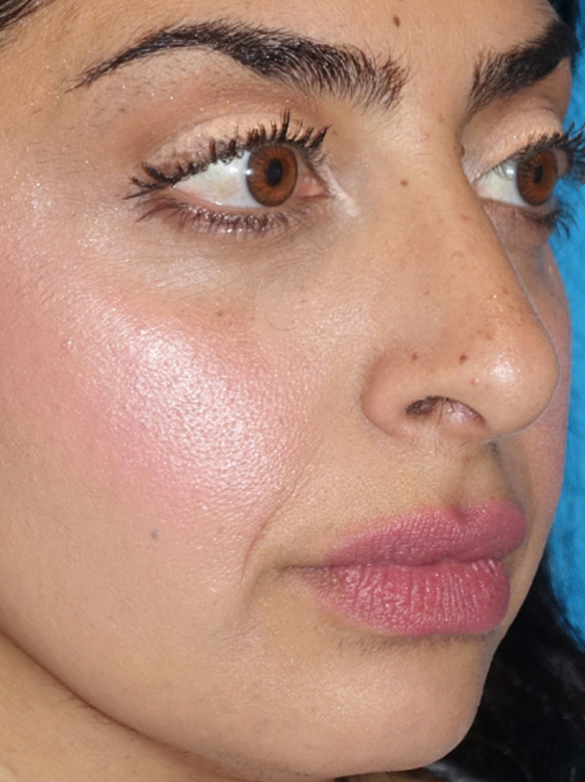 Rhinoplasty Before & After Gallery - Patient 975848 - Image 6