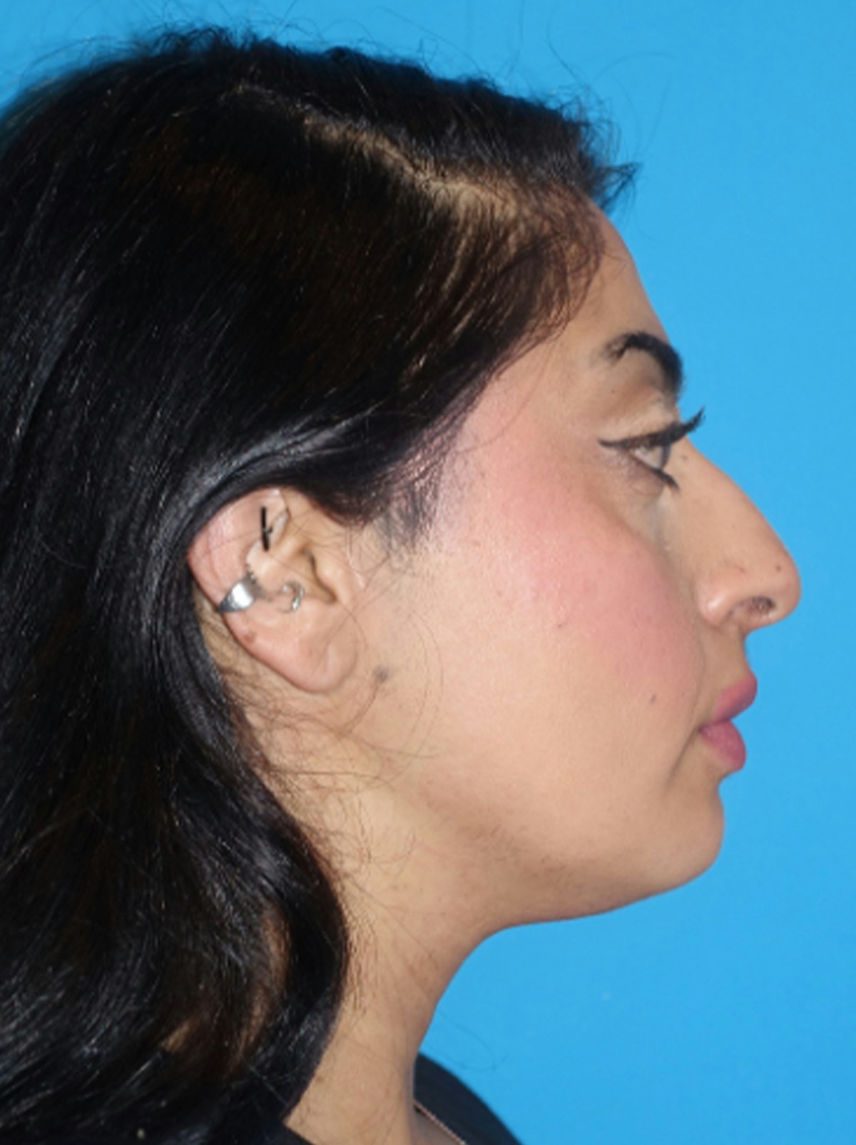 Rhinoplasty Before & After Gallery - Patient 975848 - Image 7
