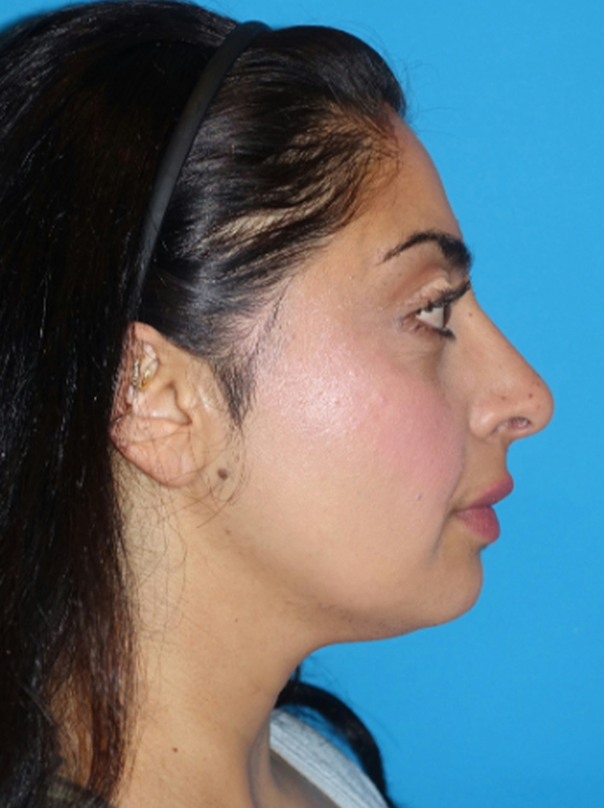 Rhinoplasty Before & After Gallery - Patient 975848 - Image 8