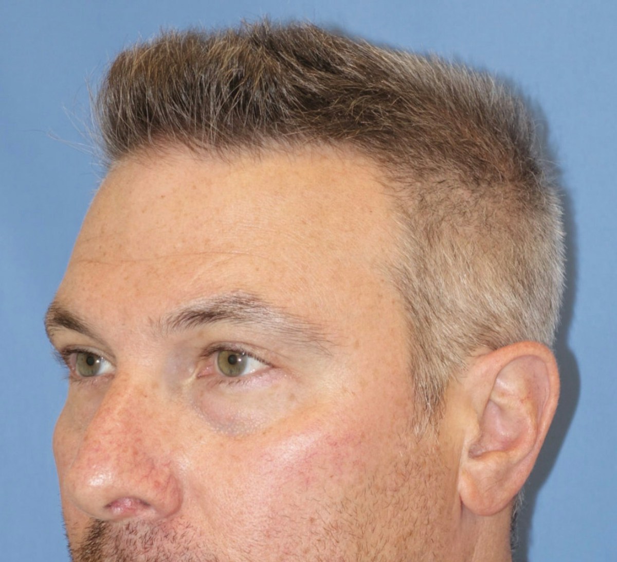 Juvéderm - Tear Troughs Before & After Gallery - Patient 111928 - Image 1