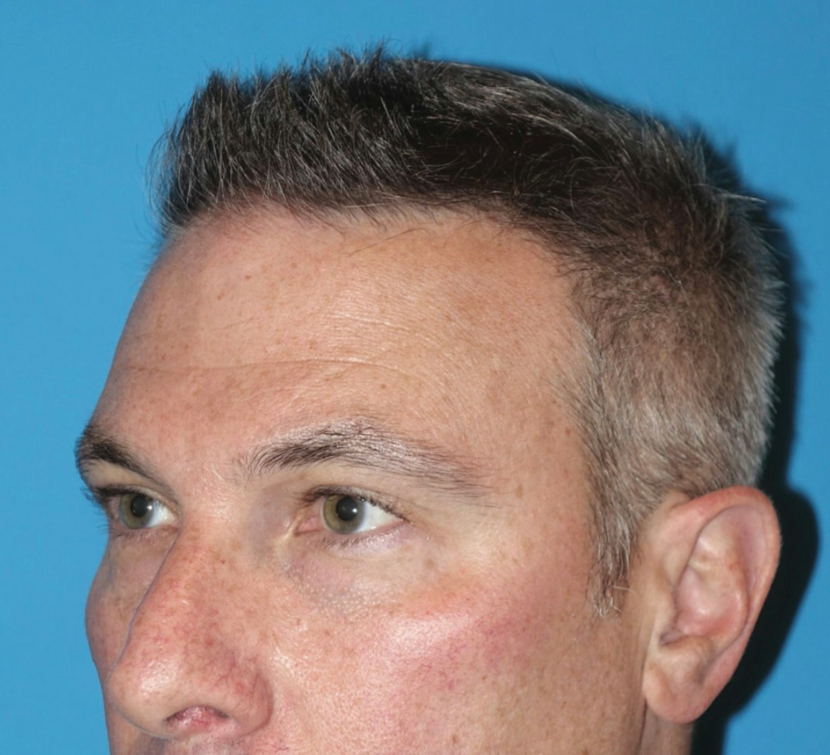 Juvéderm - Tear Troughs Before & After Gallery - Patient 111928 - Image 2