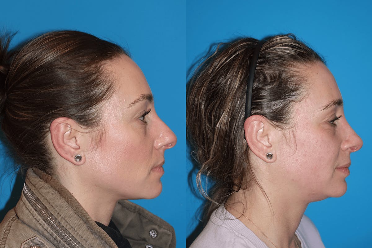Rhinoplasty Before & After Gallery - Patient 972076 - Image 2